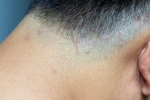 Nấm da đầu là tình trạng nhiễm trùng trên bề mặt da đầu và nang tóc do nấm gây ra.