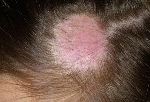 Nấm da đầu có thể dẫn tới rụng tóc từng mảng.