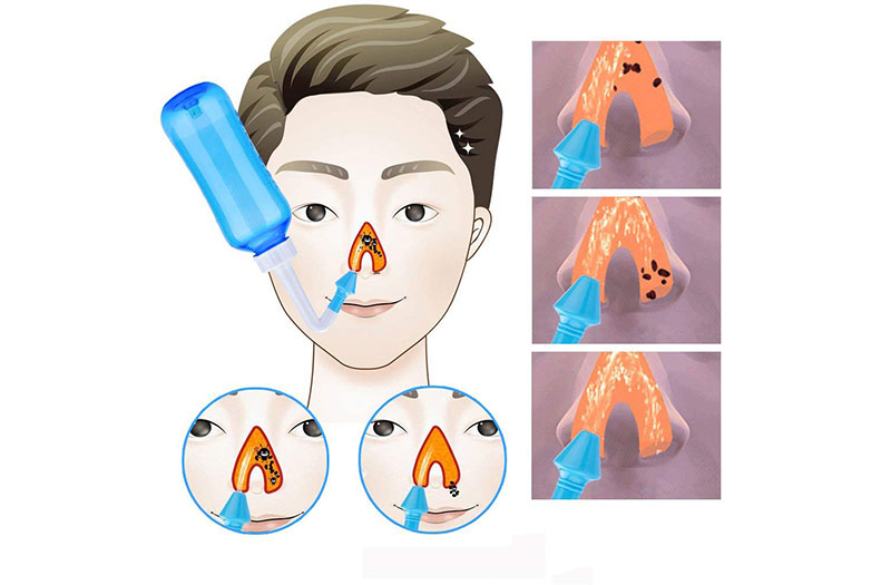 Rửa mũi bằng nước muối sinh lý.