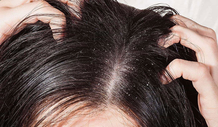 Thiếu độ ẩm khiến da đầu bị khô, căng, bong tróc và gây ngứa