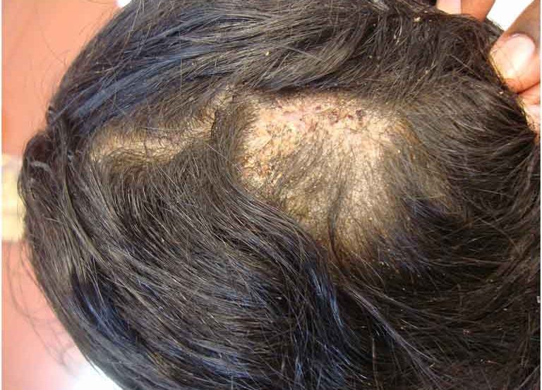 Nấm da đầu gây ngứa ngáy cho phụ nữ mang thai