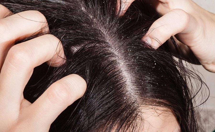 Da đầu nhiều bã nhờn là nơi khởi phát nhiều nguyên nhân gây ngứa như khô, gàu và viêm nhiễm