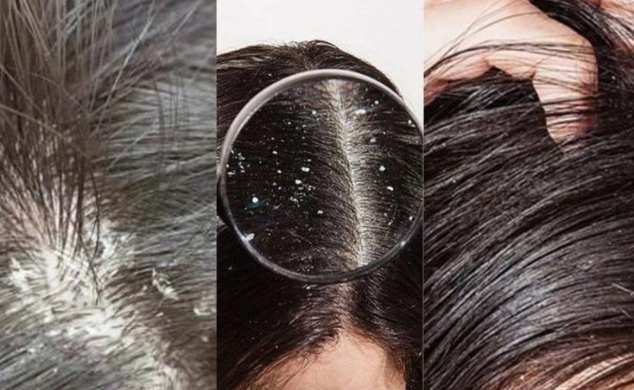 Nấm da đầu có nguy hiểm không?