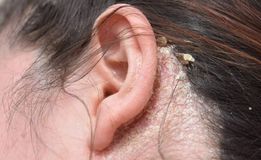 Mỗi giai đoạn nấm da đầu sẽ có biểu hiện khác nhau