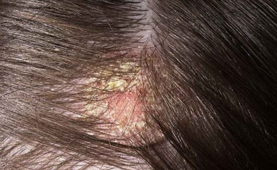 Sử dụng thuốc điều trị nấm da đầu giúp cải thiện tình trạng