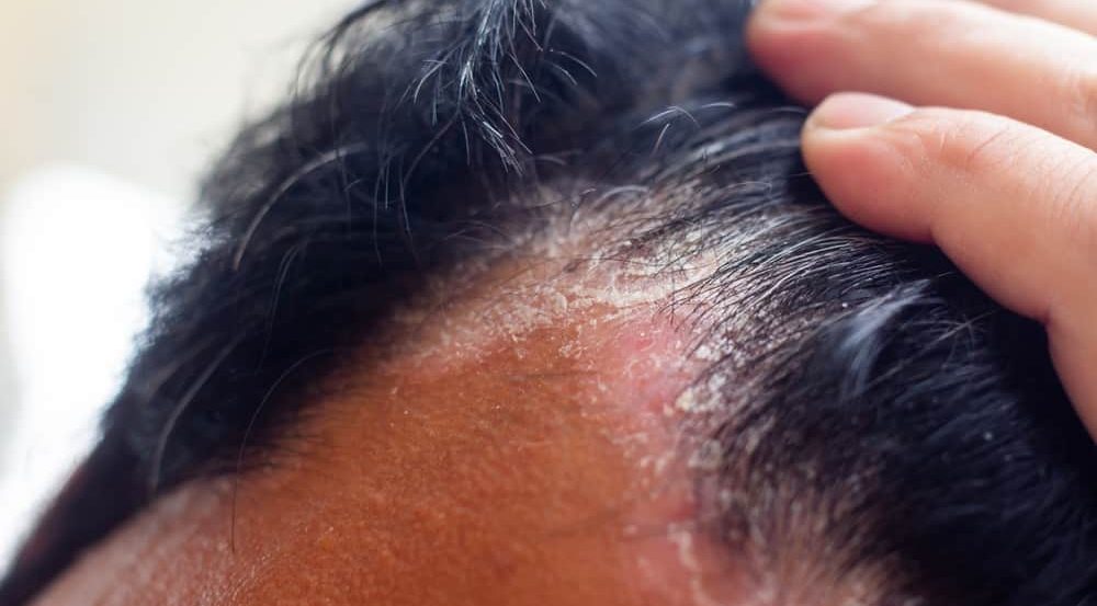 nguyên nhân bị nấm da dầu do đâu?