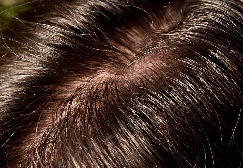 Tăng tiết bã nhờn da đầu dễ hức đẩy nấm da đầu