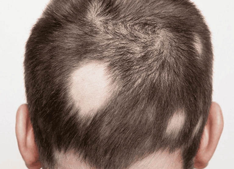 Tóc rụng thành mảng kết hợp viêm da gàu nặng là dấu hiệu điển hình của bệnh.