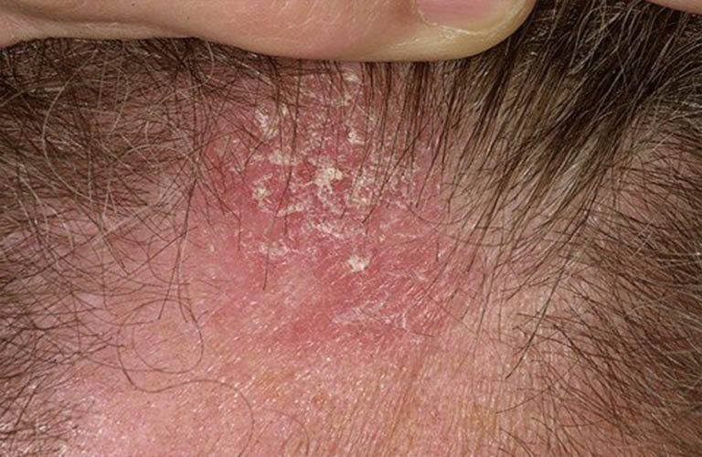 Bị viêm da tiết bã là nguyên nhân ngứa da đầu phổ biến.