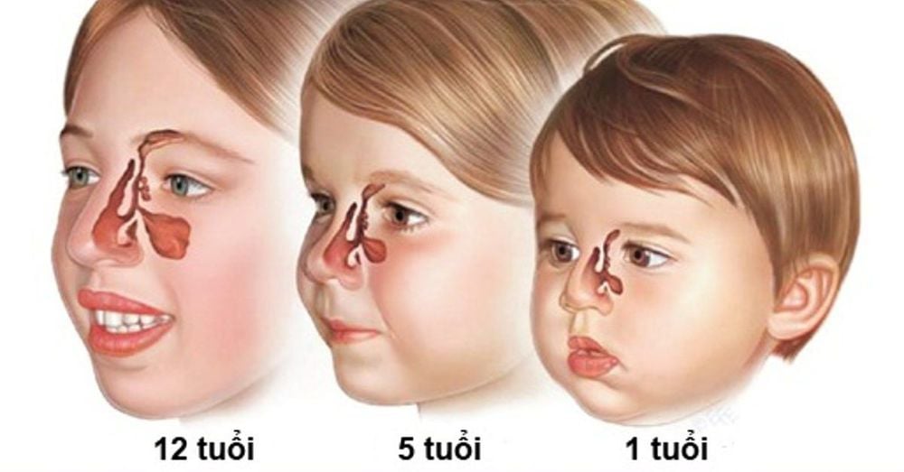 Sổ mũi kéo dài có thể do viêm mũi, dị ứng hoặc biến chứng như viêm xoang, viêm tai giữa
