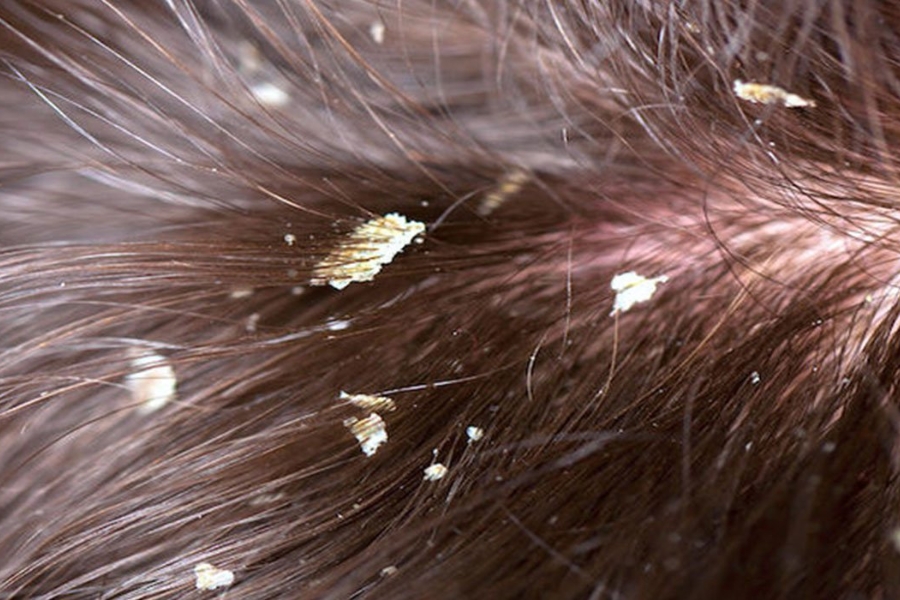 Nhiều trường hợp cần sử dụng dầu gội đặc trị gàu nấm riêng biệt