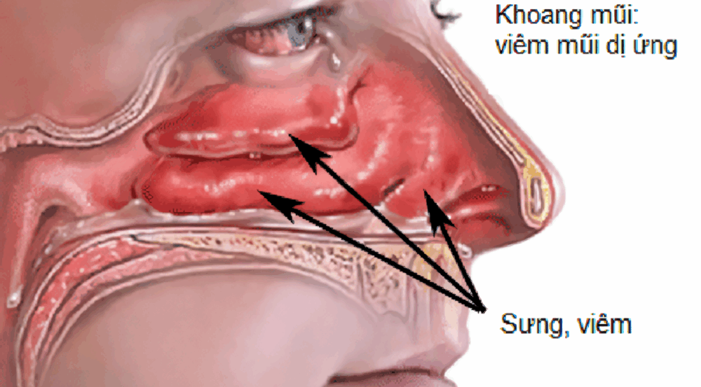 Biểu hiện của tình trạng nghẹt mũi mãn tính
