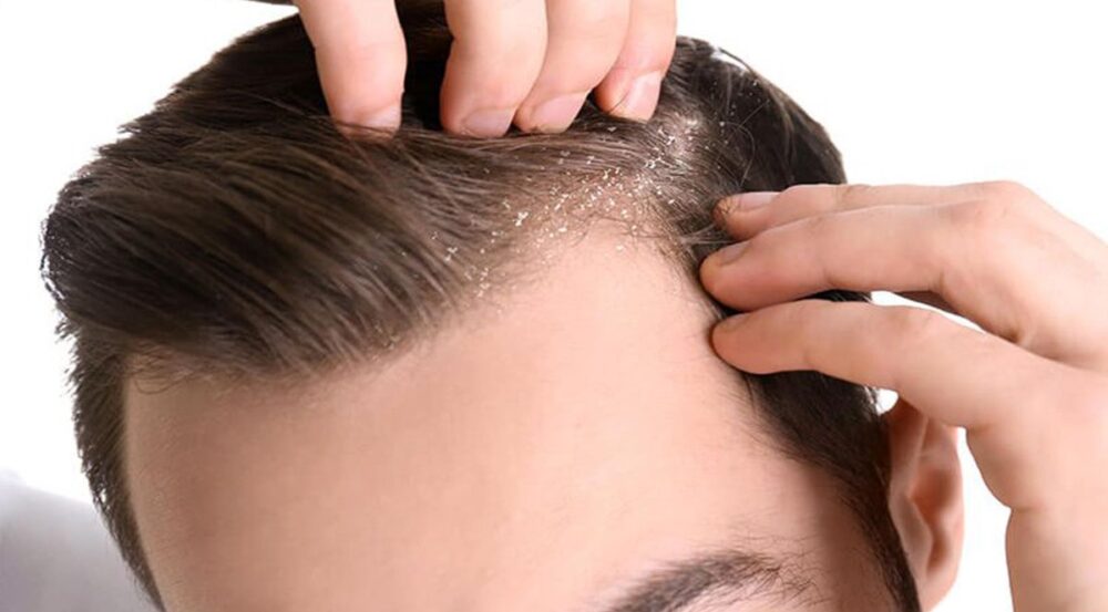 Có những cách trị gàu cho nam giới nào hiệu quả?