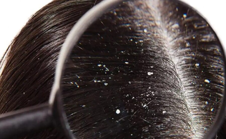 Nguyên nhân gây gàu