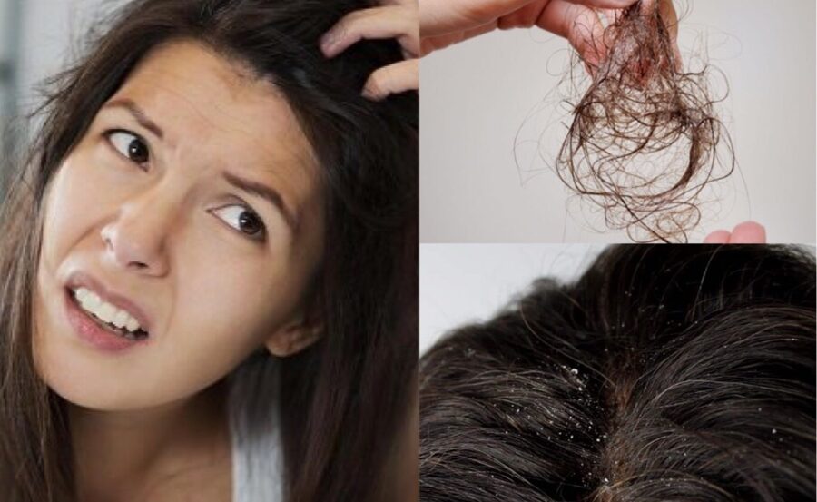 Gàu và rụng tóc là hai vấn đề da đầu phổ biến