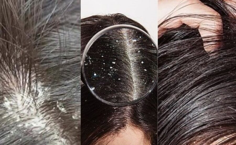 Gàu và rụng tóc là hai vấn đề da đầu phổ biến ở mọi độ tuổi do nhiều nguyên nhân