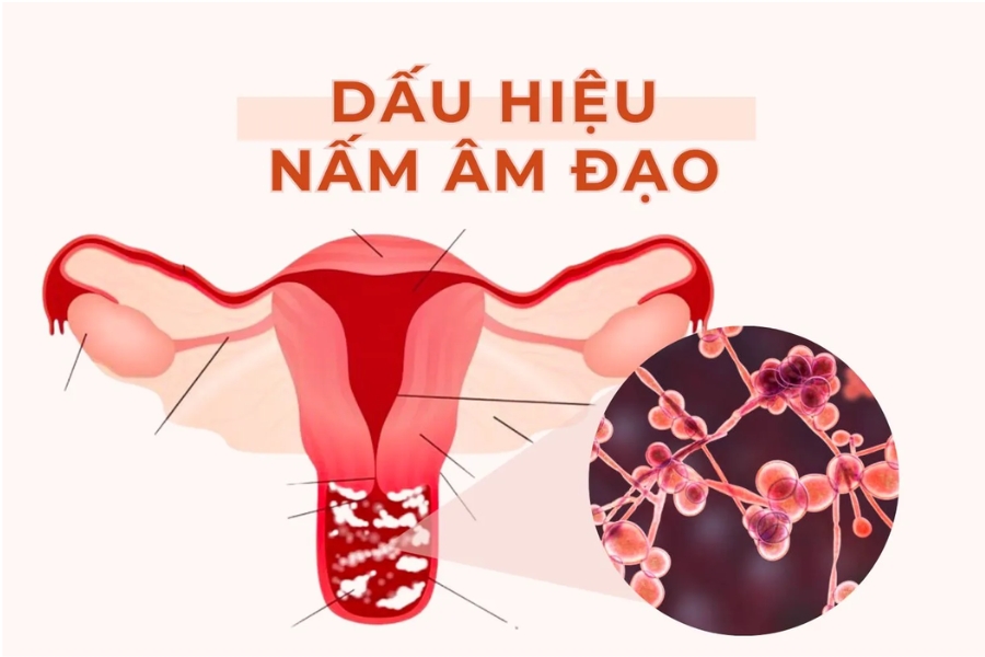 cach-chua-nam-candida-o-vung-kin-tai-nha-2