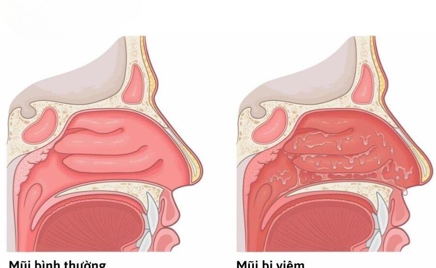Mũi bị viêm khiến cho niêm mạc phù nề, tăng tiết nhầy gây nghẹt