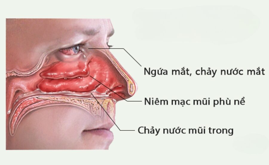 Phù nề niêm mạc khiến cho đường thở bị thu hẹp gây nghẹt mũi