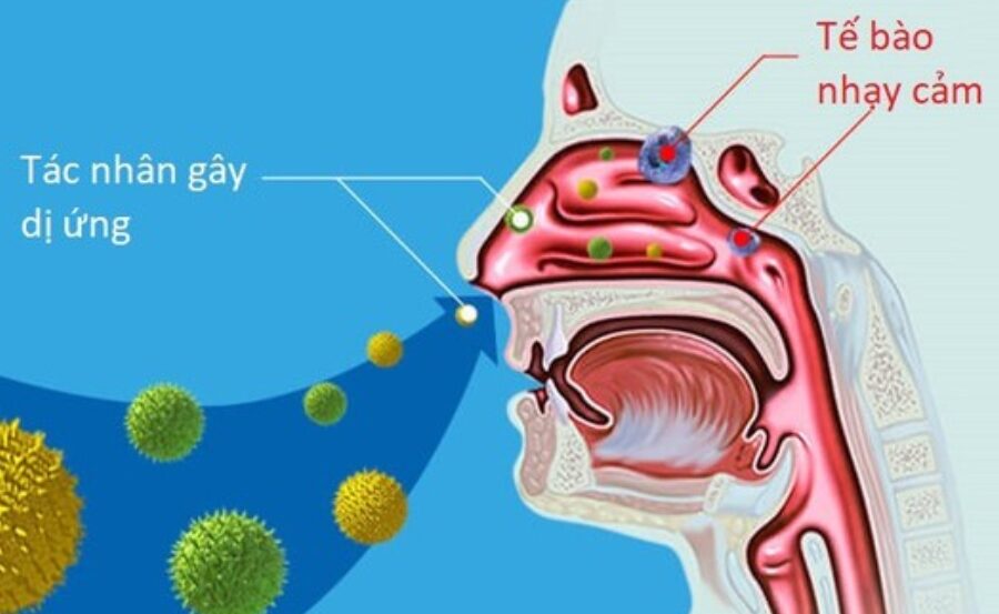 Các chất dị ứng khiến niêm mạc mũi bị kích thích, phù nề gây nghẹt