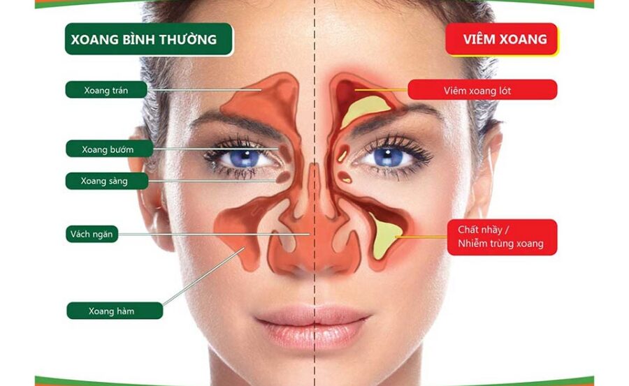 Dịch nhầy tích tụ trong các hốc xoang khiến cho người bệnh bị nghẹt mũi