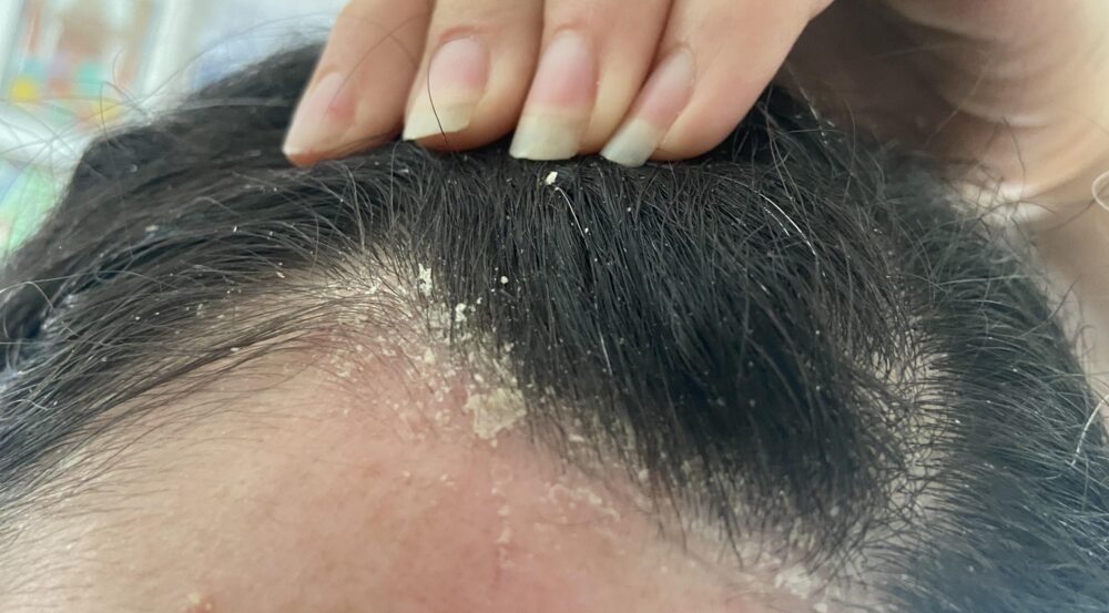 Gàu có thể đi kèm với các triệu chứng khác như ngứa, kích ứng và mẩn đỏ trên da đầu.