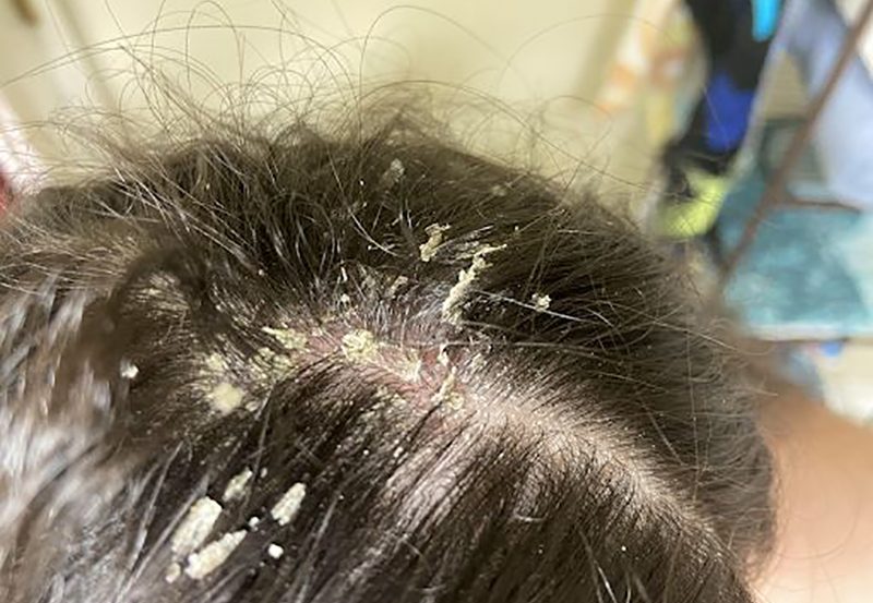 Gàu là tình trạng phổ biến gặp ở nhiều người. Vậy đâu là cách trị gàu dứt điểm?