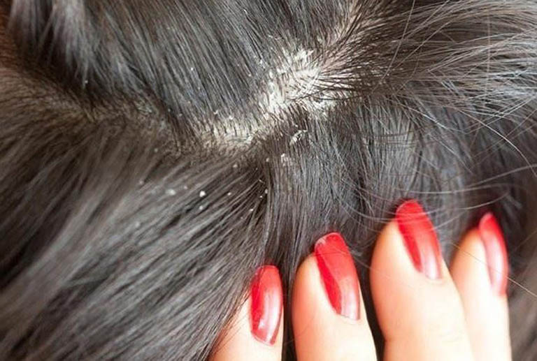 Da đầu quá khô hoặc quá dầu đều có thể sinh ra gàu, ngứa.