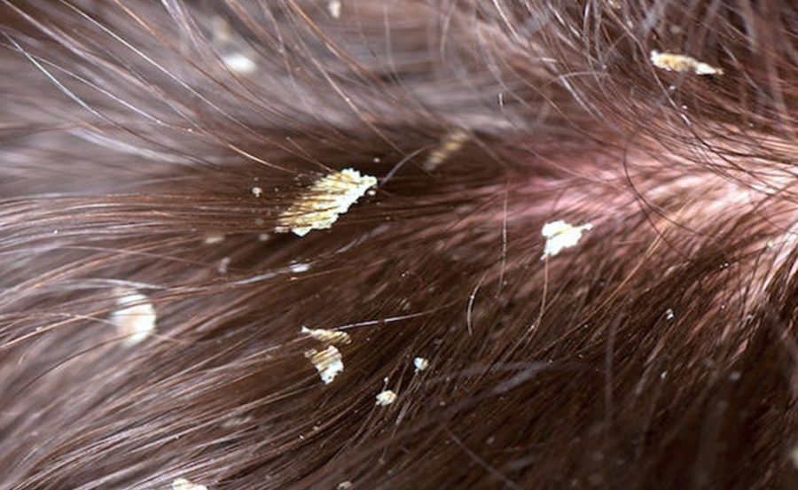 Gàu là hiện tượng các mảng tế bào chết bong tróc khỏi lớp biểu bì của da đầu