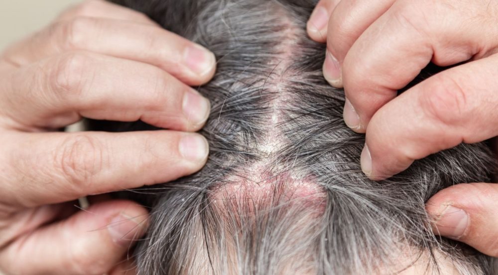 Sử dụng dầu gội trị nấm tóc để làm sạch nấm gây bệnh.