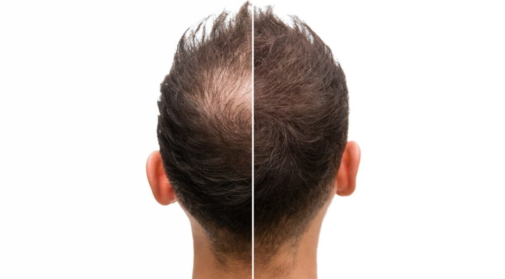 Dầu gội trị nấm tóc hỗ trợ phục hồi tóc rụng do nấm.