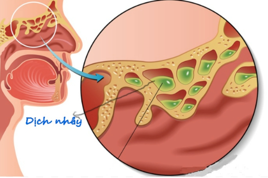 Dịch nhầy nhiều gây bít tắc đường thở cần được loại bỏ giúp lưu thông mũi