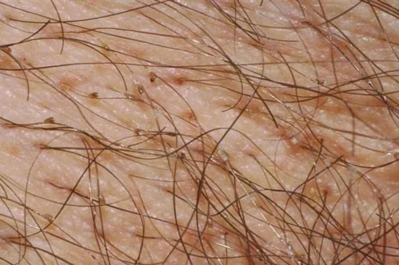 nguyen-nhan-bi-ngua-vung-kin-4