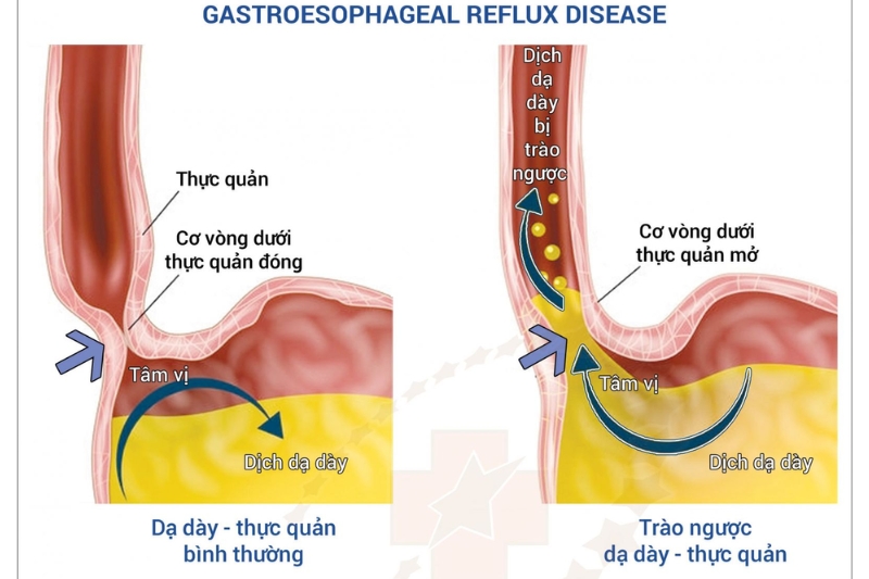 cach-tri-day-bung-kho-tieu-tai-nha-6