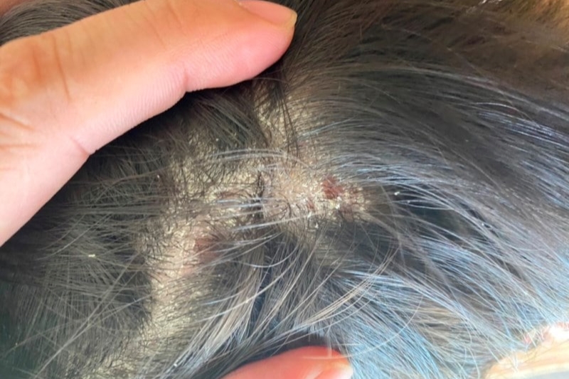 Nấm da đầu rất dễ lây lan gây ra các tổn thương trên da đầu và nang tóc