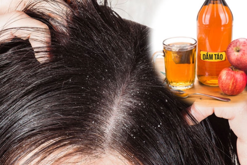 Dấm táo là một mẹo để hỗ trợ cải thiện tình trạng nấm da đầu hiệu quả