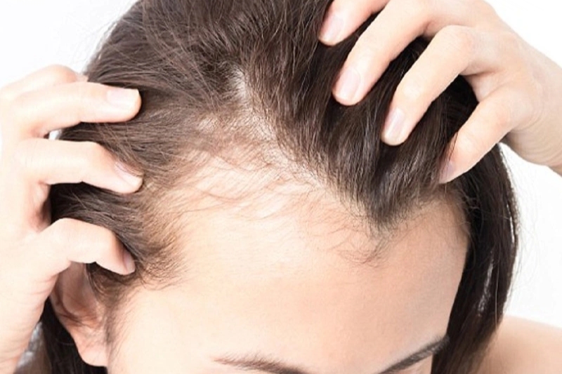 nhiễm nấm nhẹ có thể thử áp dụng các biện pháp trị nấm da đầu tự nhiên