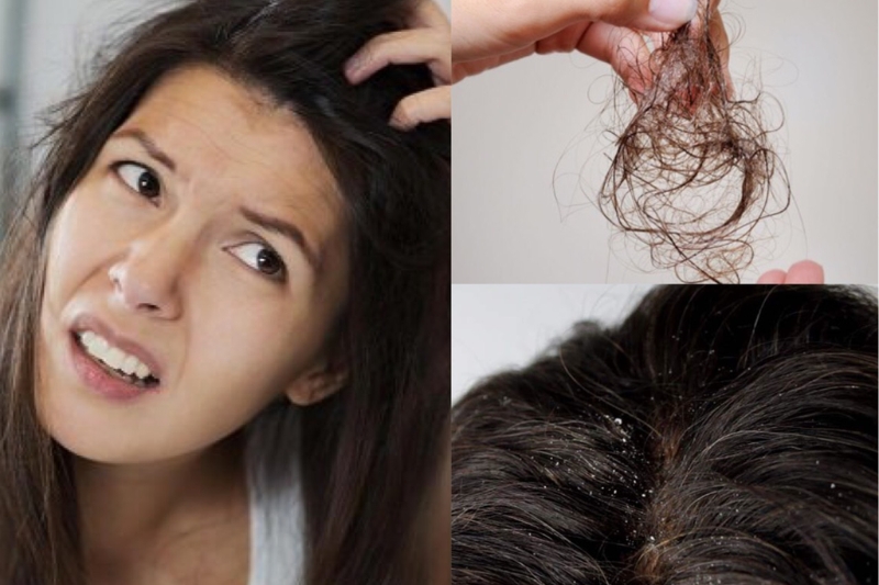 Cách trị ngứa da đầu và rụng tóc tại nhà