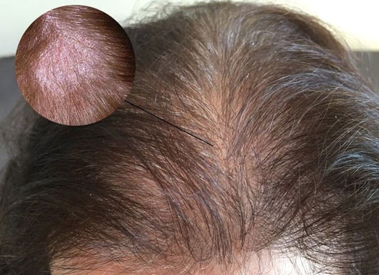 Da đầu có dấu hiệu viêm