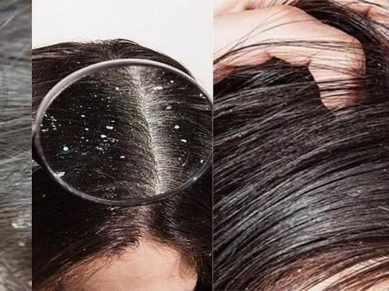 Kiểm soát tình trạng bã nhờn bằng dầu gội sạch gàu là biện pháp hạn chế gàu