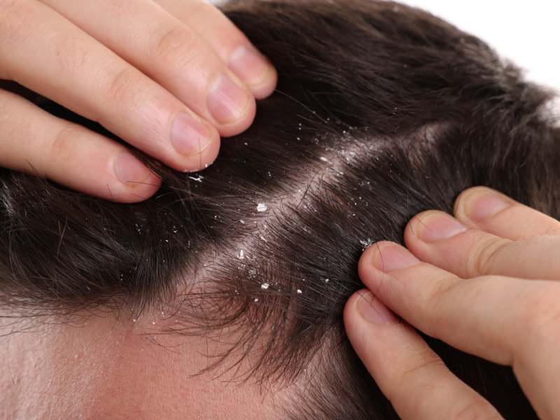 Để chọn được dầu gội trị gàu tốt nhất cho nam, cần dựa trên đặc điểm da đầu