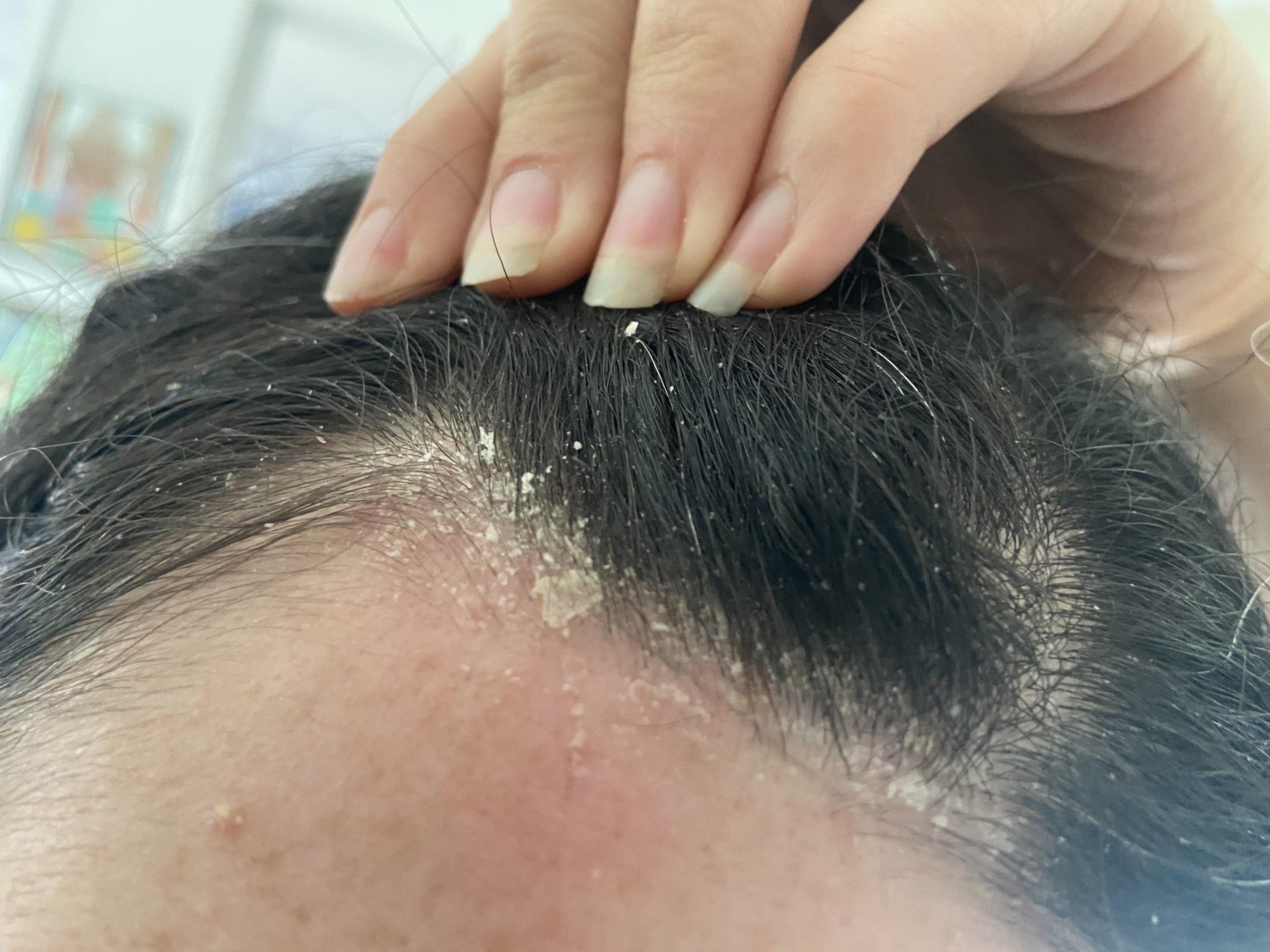 Làm cách nào để sạch gàu? 7 cách trị gàu hiệu quả tại nhà