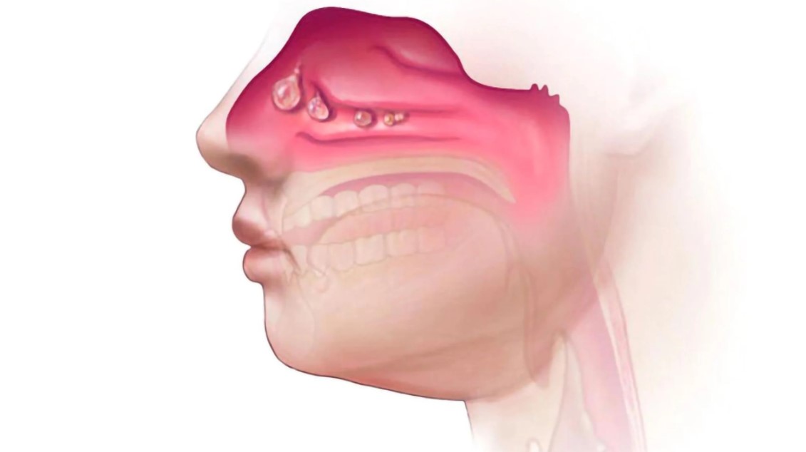 Nghẹt mũi khó thở có thể do polyp
