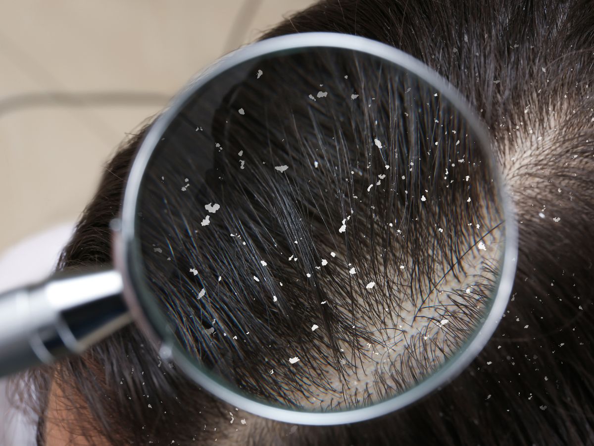 Gàu là tình trạng da đầu bị bong tróc bất thường, tạo thành những mảng nhỏ