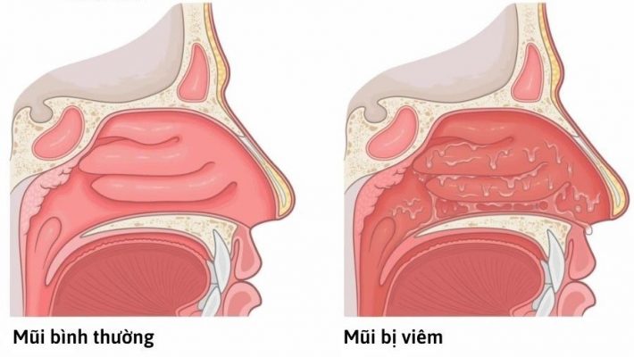 Tình trạng viêm mũi sản xuất nhiều chất nhầy hơn bình thường