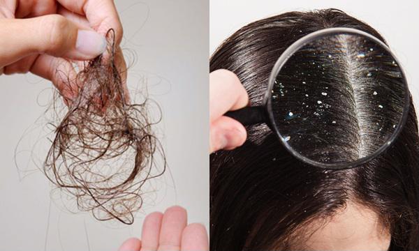 Gàu và rụng tóc là hai vấn đề có liên quan mật thiết với nhau.