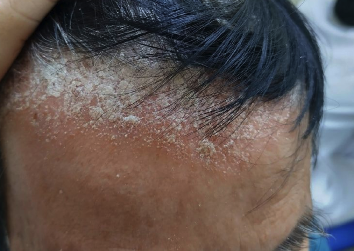 Đâu là cách trị gàu cho nam gới hiệu quả