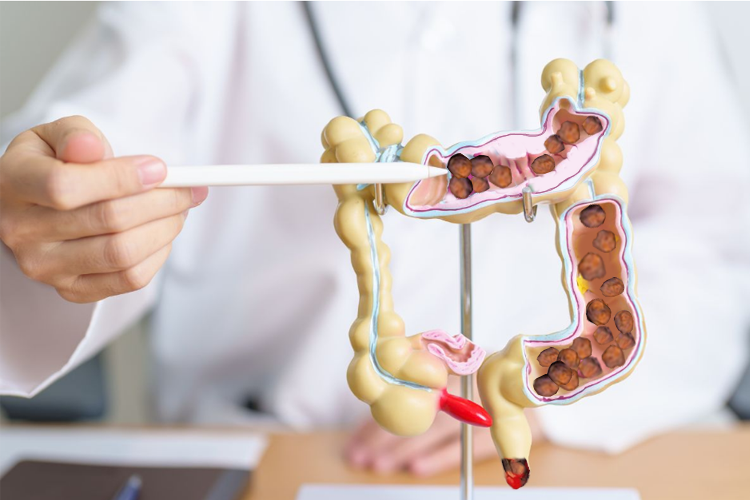 nguyen-nhan-bi-tao-bon-1