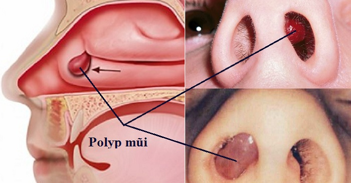 Người có polyp mũi thường dễ mắc viêm mũi xoang