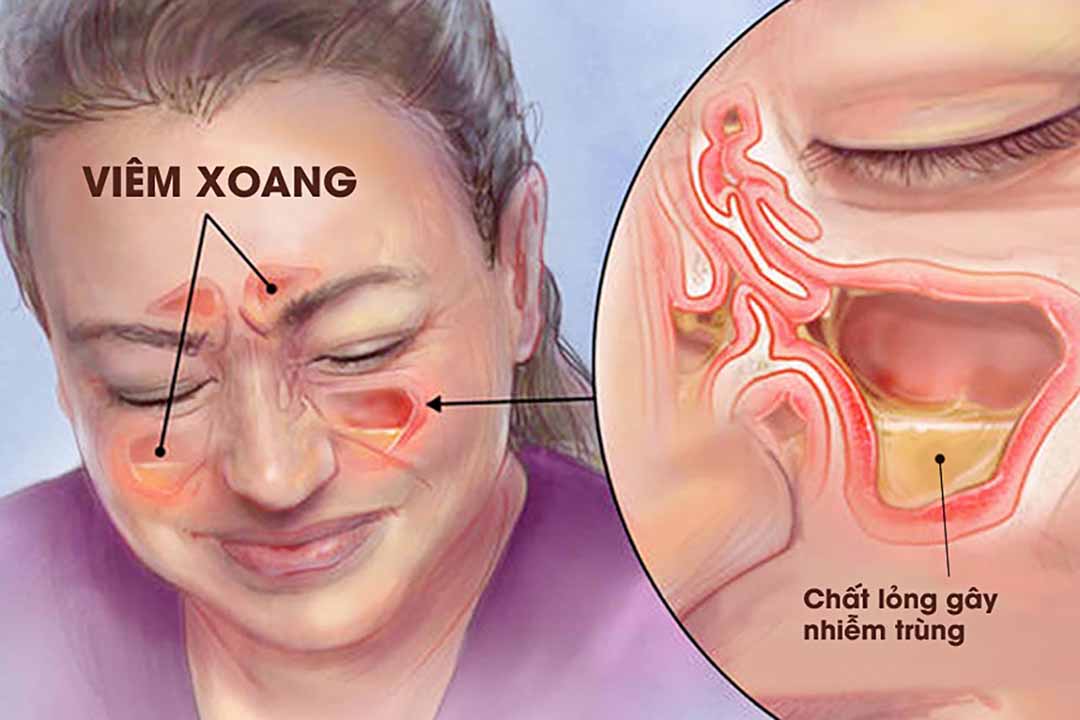 Nhận diện bệnh viêm xoang dị ứng